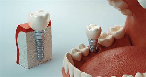 implantes dentales en costa rica