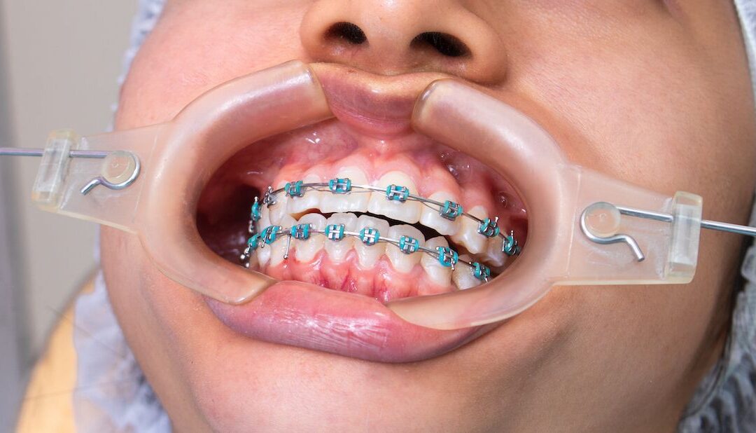 Cuánto cuesta ponerse brackets en Costa Rica