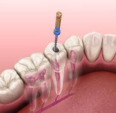 Aspectos importantes de la endodoncia